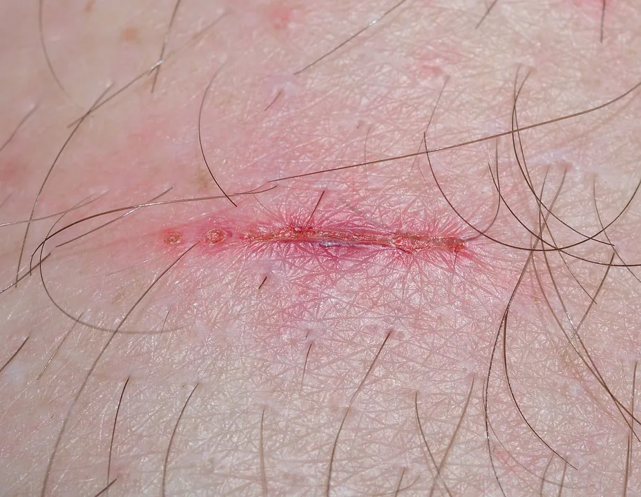 Wound 321361 960 720 Jpg.webp